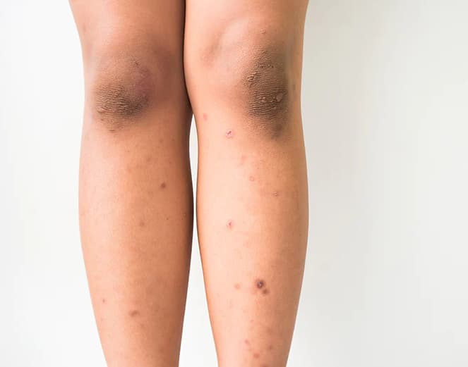 How to Get Rid of Dark Spots on Legs