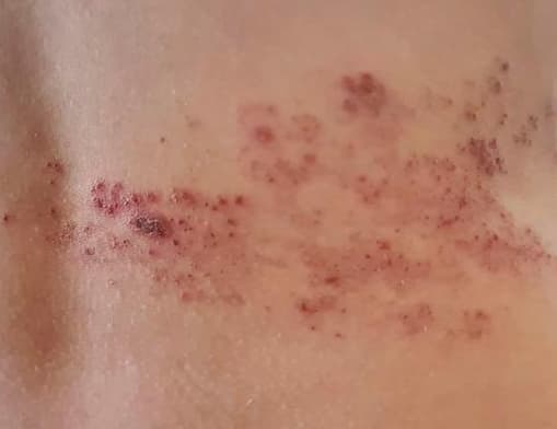 How Long Does It Take for Herpes To Show Up After Exposure